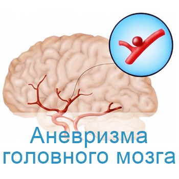 терапия аневризмы головного мозга