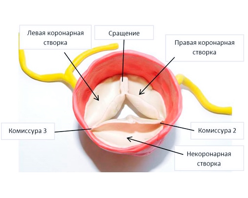 Традиционная операция по замене клапана с вскрытием грудной клетки